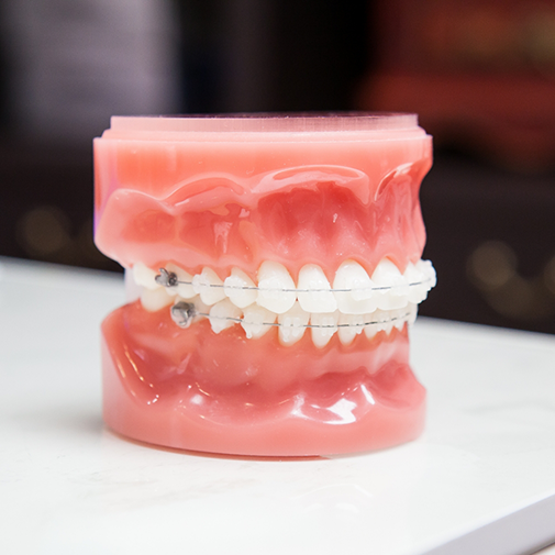 Model of teeth with clear/ceramic braces