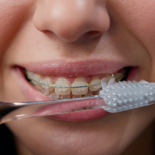 Person with clear/ceramic braces about to brush teeth