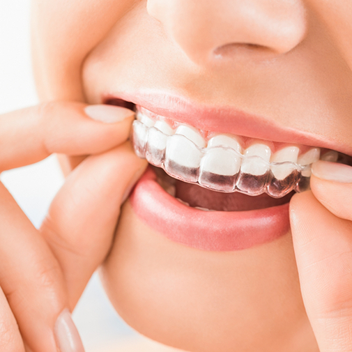 Close up of woman putting in a clear aligner