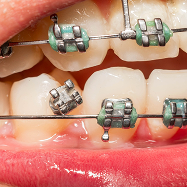 Close up of braces with loose bracket