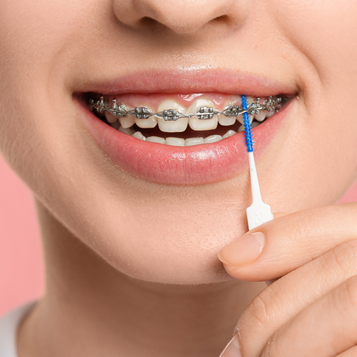 Using interdental brush to clean under braces