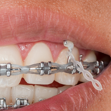 Close up of braces with loose band