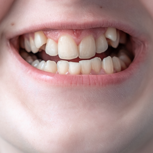 Close up of badly misaligned teeth